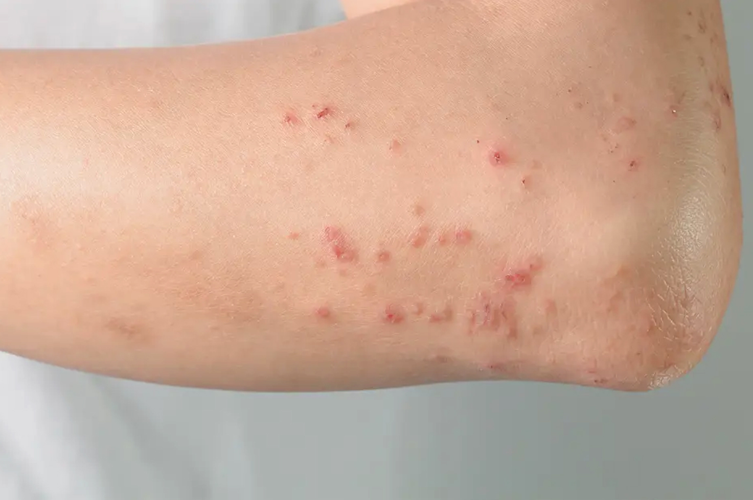 What are the of causes hives? | What are the symptoms of hives? | How long do hives last? | When to seek medical treatment for hives? | How are the hives treated and cured? | Various pictures of hives | diseases that cause hives in adults male and female | what are the Causes of hives in female adults | Can hives be a sign of something serious diseases |Various treatment of hives | How to cure hives fast and quick | Pictures of hives rash on legs and hand